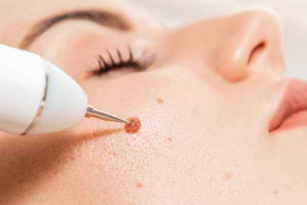CryoPen: 5 Skin Concerns It May Be Used to Treat 3 What actually happens during a CryoPen treatment Tilbury?