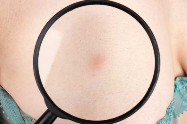 Dermatofibromas: What to Know About Treatment Options 3 Dermatofibromas: What to Know About Treatment Options