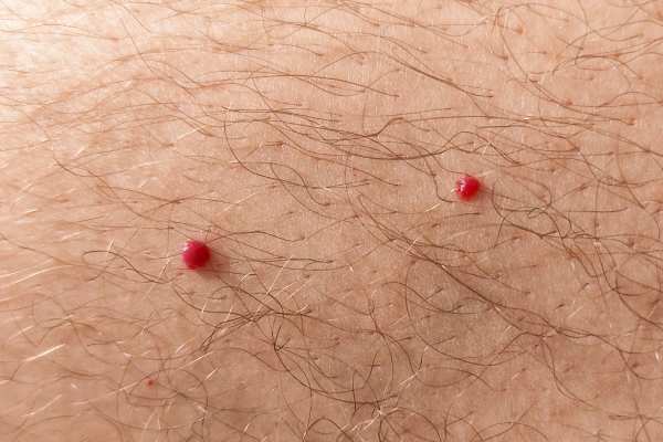 CryoPen: 5 Skin Concerns It May Be Used to Treat 2 cherry angioma removal Tilbury