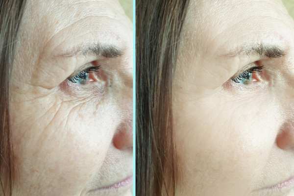 Why Do People Choose HIFU for a Non-Surgical Facelift? 4 How long can HIFU results last Tilbury?