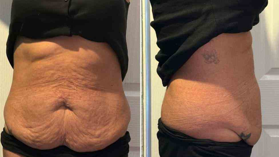Lost the Weight but Not the Loose Skin? What You Should Know 1 Is It Definitely Loose Skin Tilbury?